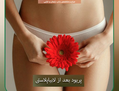 پریود بعد از لابیاپلاستی و تاثیرات آن بر نتیجه جراحی